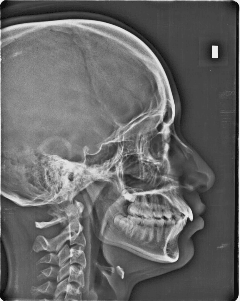 Cephalometric Dental X-Rays in Fremont