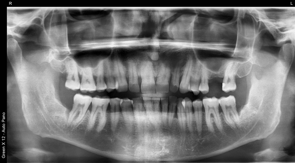 Panoramic Dental X-Rays in Fremont